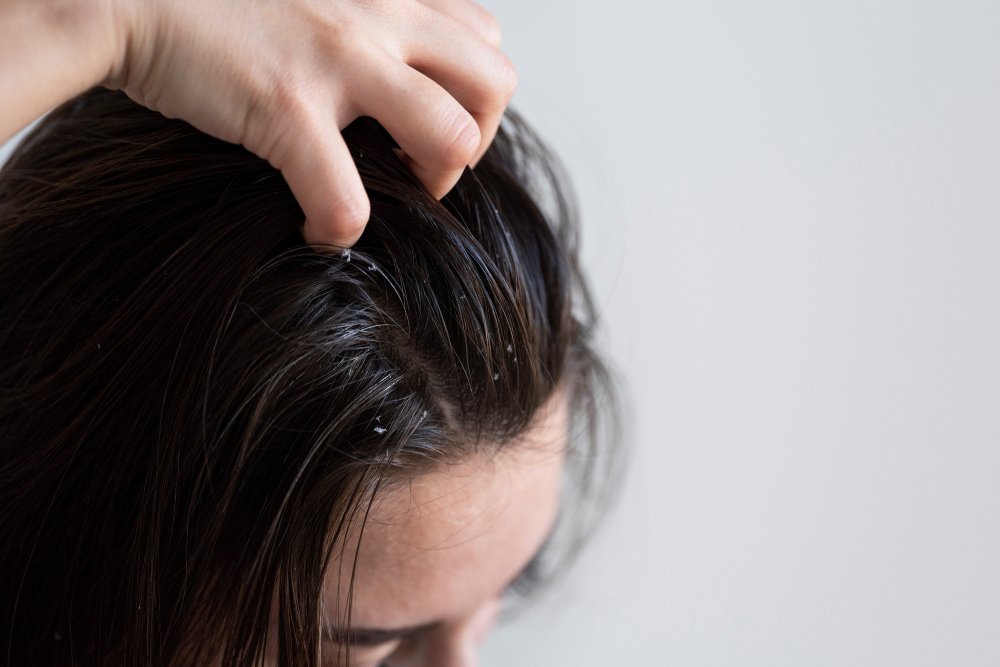 Atasi Minyak pada Rambut, Yuk, Intip Tips Sederhana Ini!